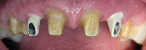 Unrestored Anterior Dental Implants