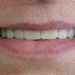 Smile profile with restored dental implants