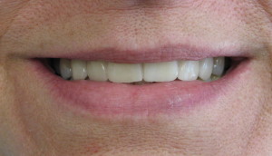 Smile profile with restored dental implants