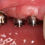 Dental Implants & Abutments