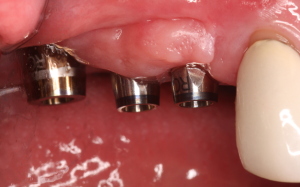 Dental Implants & Abutments
