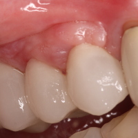 Porcelain Teeth / Dental Implants