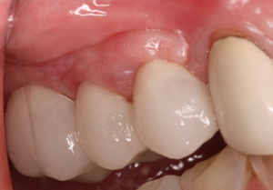 Porcelain Teeth / Dental Implants