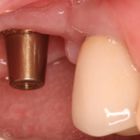 Posterior Dental Implant w/o Crown