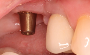 Posterior Dental Implant w/o Crown