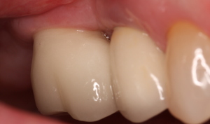 Completed dental implant restoration