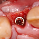 Tooth Extraction / Dental Implant