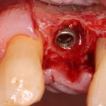 Dental Implant Placement