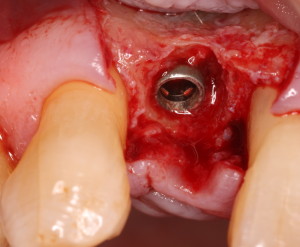 Dental Implant Placement