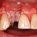 Dental Implant / Bone Graft