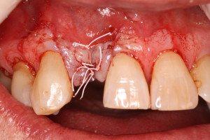 Dental Implant / Bone Graft