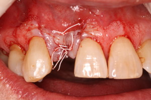 Dental Implant / Bone Graft