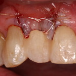 Bonded Temporary / Dental Implant