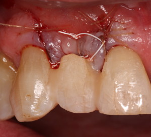 Bonded Temporary / Dental Implant