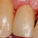 Dental Implant Provisional