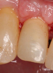Dental Implant Provisional