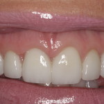 Excess Gingival Display