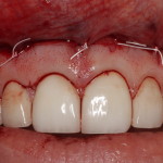 Gingival display treatment