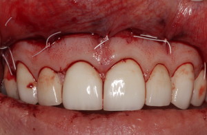 Gingival display treatment