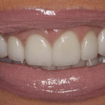 After pic of gummy smile treatment.