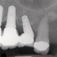 Non-restored / Mis-aligned Dental Implant