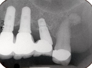 Non-restored / Mis-aligned Dental Implant
