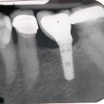 Small mis-placed dental implant.