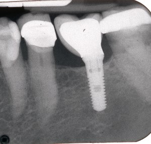 Small mis-placed dental implant.