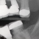 Peri-implantitis