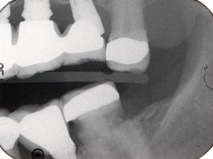 Peri-implantitis