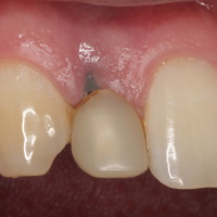 Before Treatment - Implant Revision