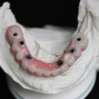 Denture Revision / Dental Implants