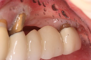 Pre Dental Implant Treatment