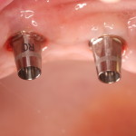 Dental Implants Prior To Crowns