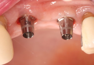 Dental Implants Prior To Crowns