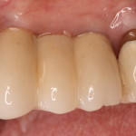 Dental Implants / Crowns