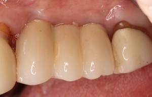 Dental Implants / Crowns