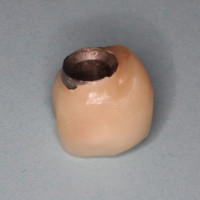 Bulbous Dental Implant Crown