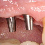 Dental Implant Alignment
