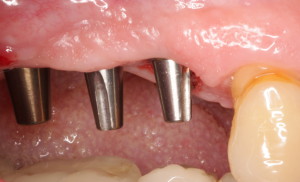 Dental Implant Alignment