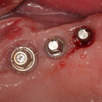 Posterior Dental Implants