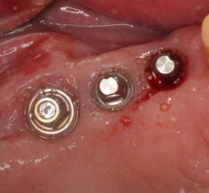 Posterior Dental Implants