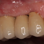 Dental Implants After Restorations