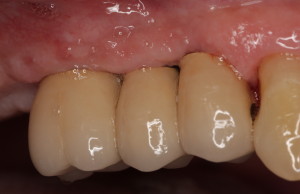 Dental Implants After Restorations